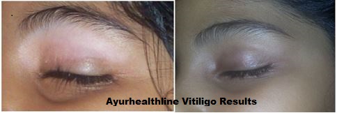Ayurvedic Vitiligo treatment 